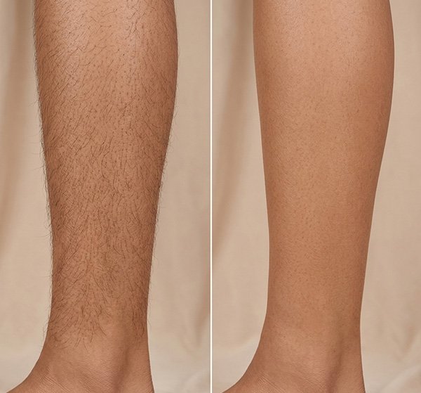 Laser Hair Reduction